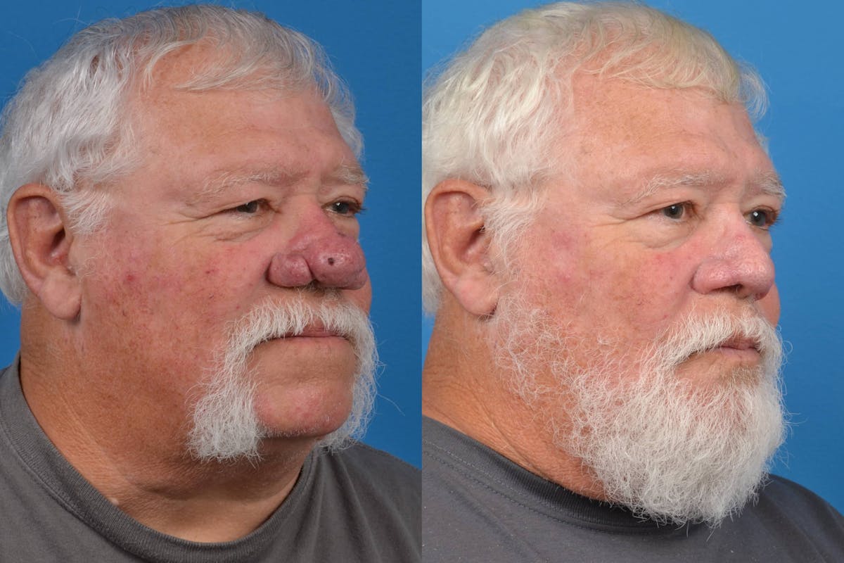 Rhinophyma Before & After Gallery - Patient 122406496 - Image 2