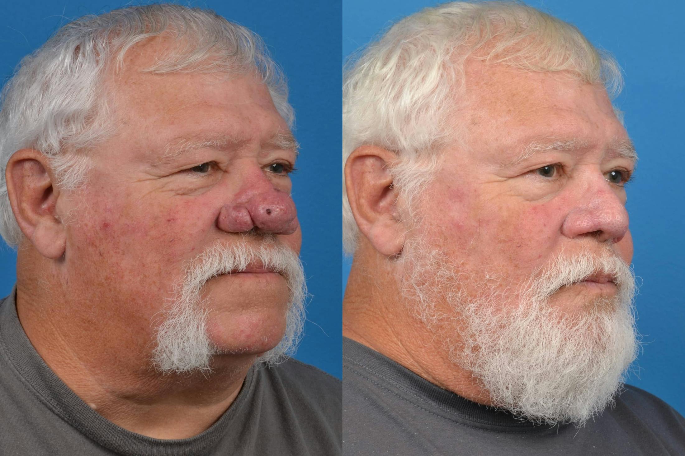 Rhinophyma Before & After Gallery - Patient 122406496 - Image 2