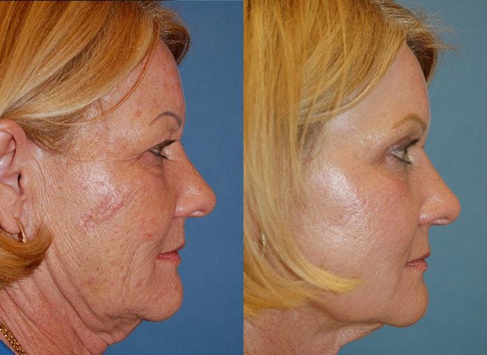Laser Assisted Weekend Neck Lift Gallery - Patient 122406490 - Image 1