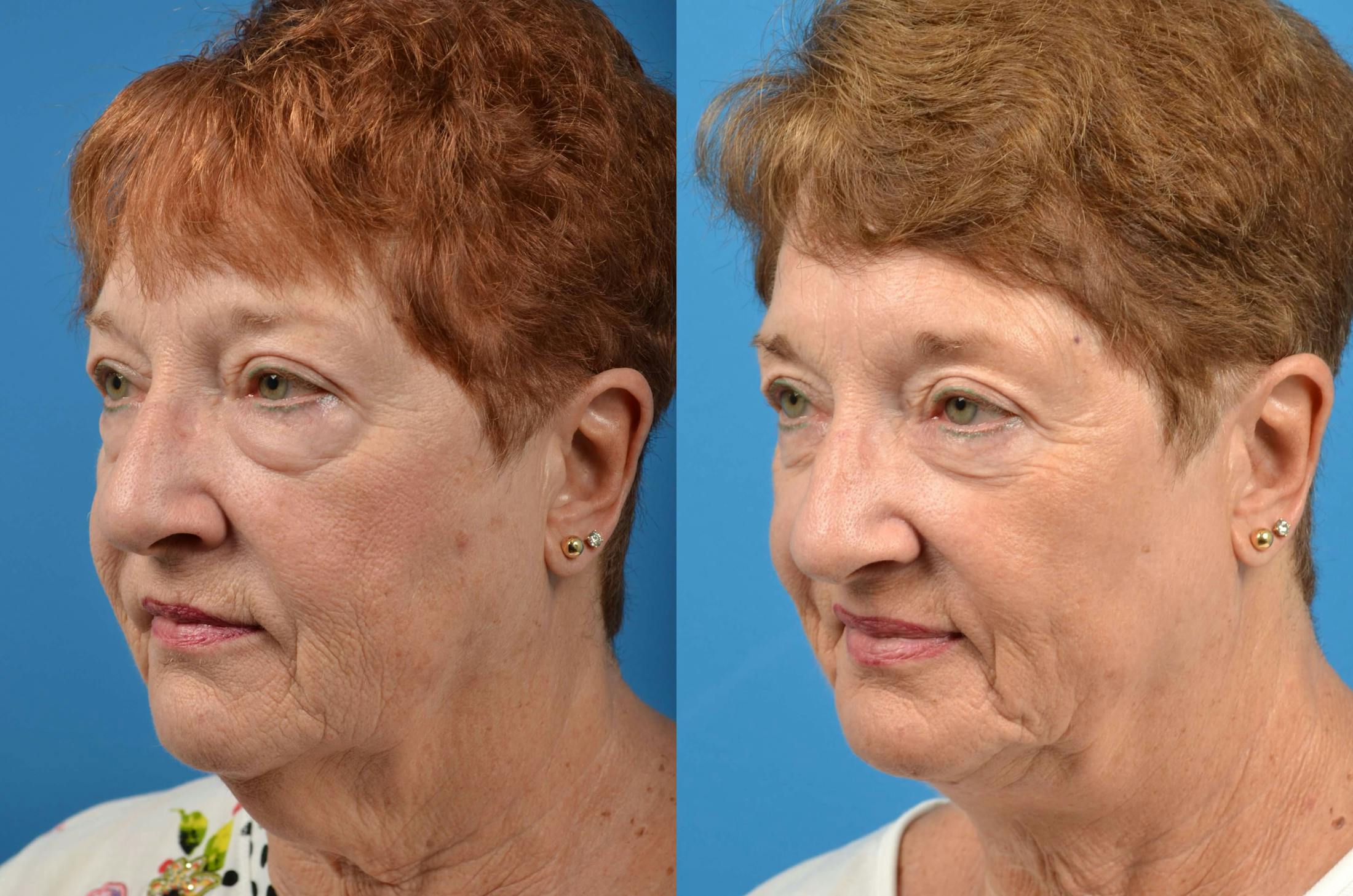 Profile Neck Lift Before & After Gallery - Patient 122406494 - Image 3