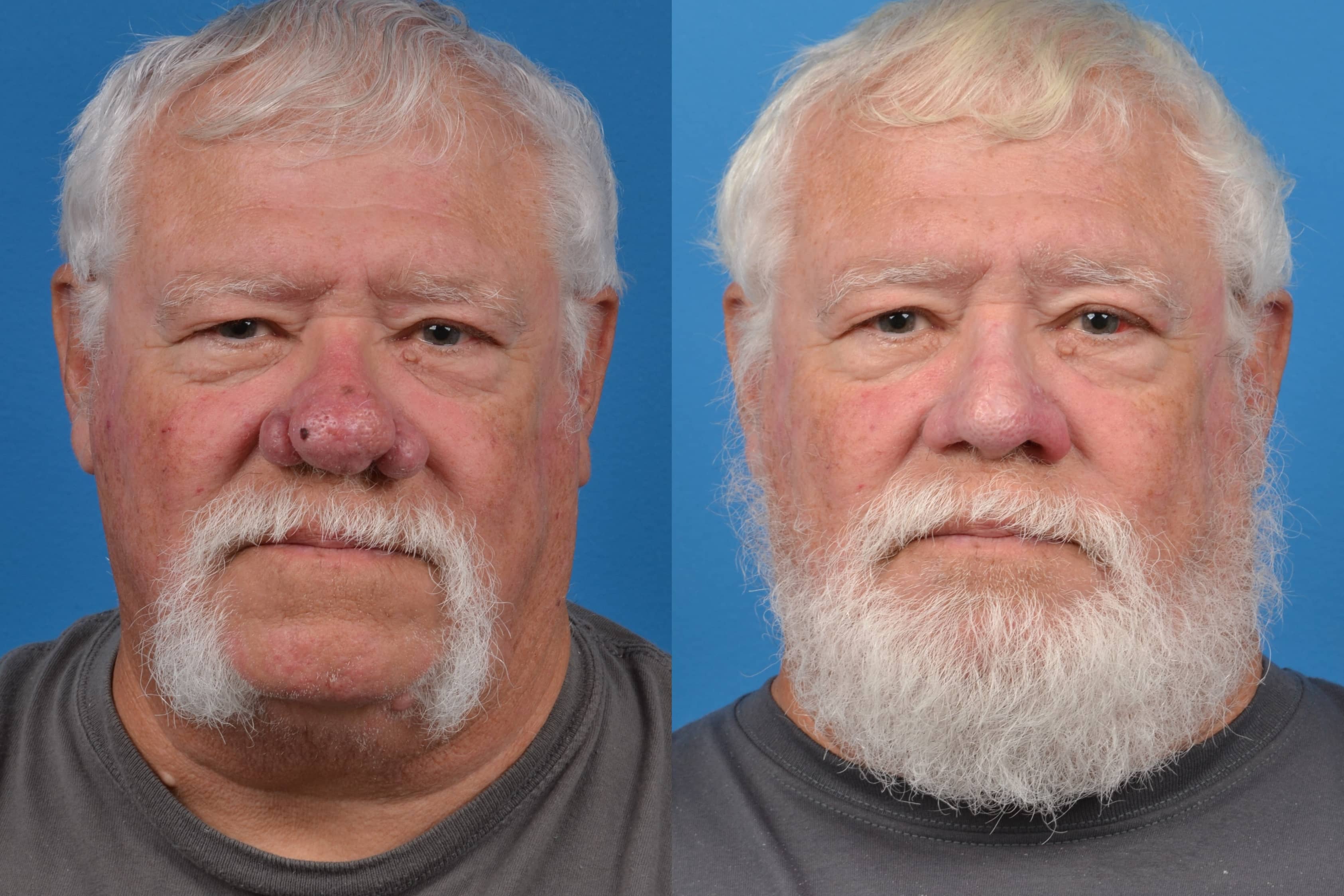 Rhinophyma Before & After Gallery - Patient 122406496 - Image 3