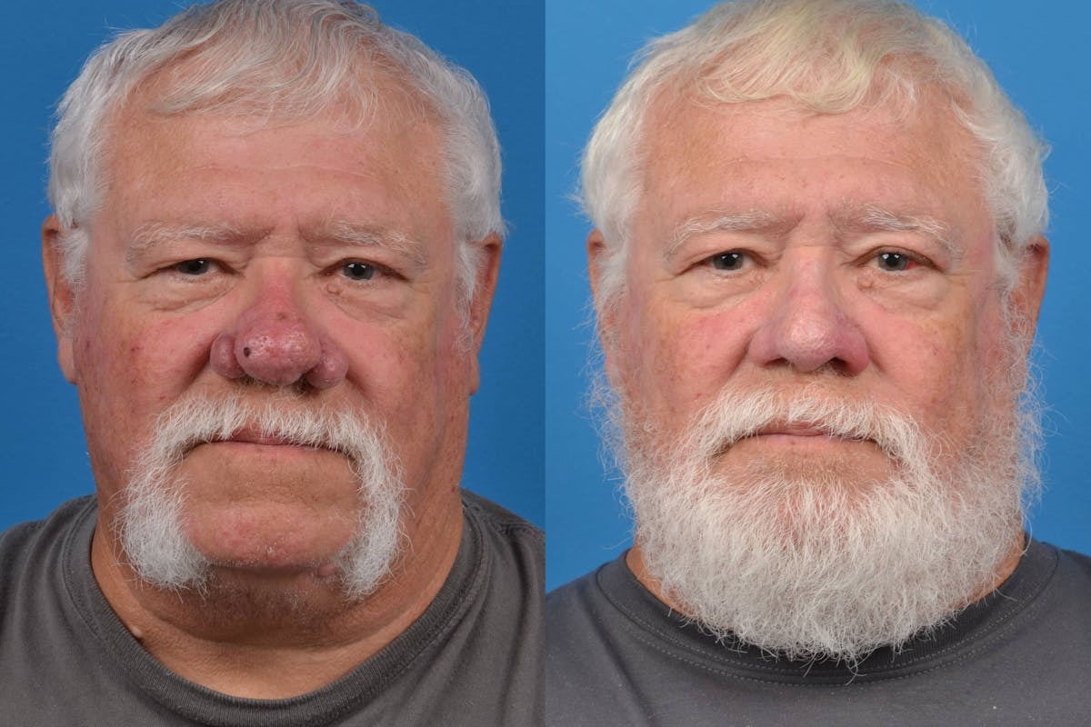 Rhinophyma Before & After Gallery - Patient 122406496 - Image 3