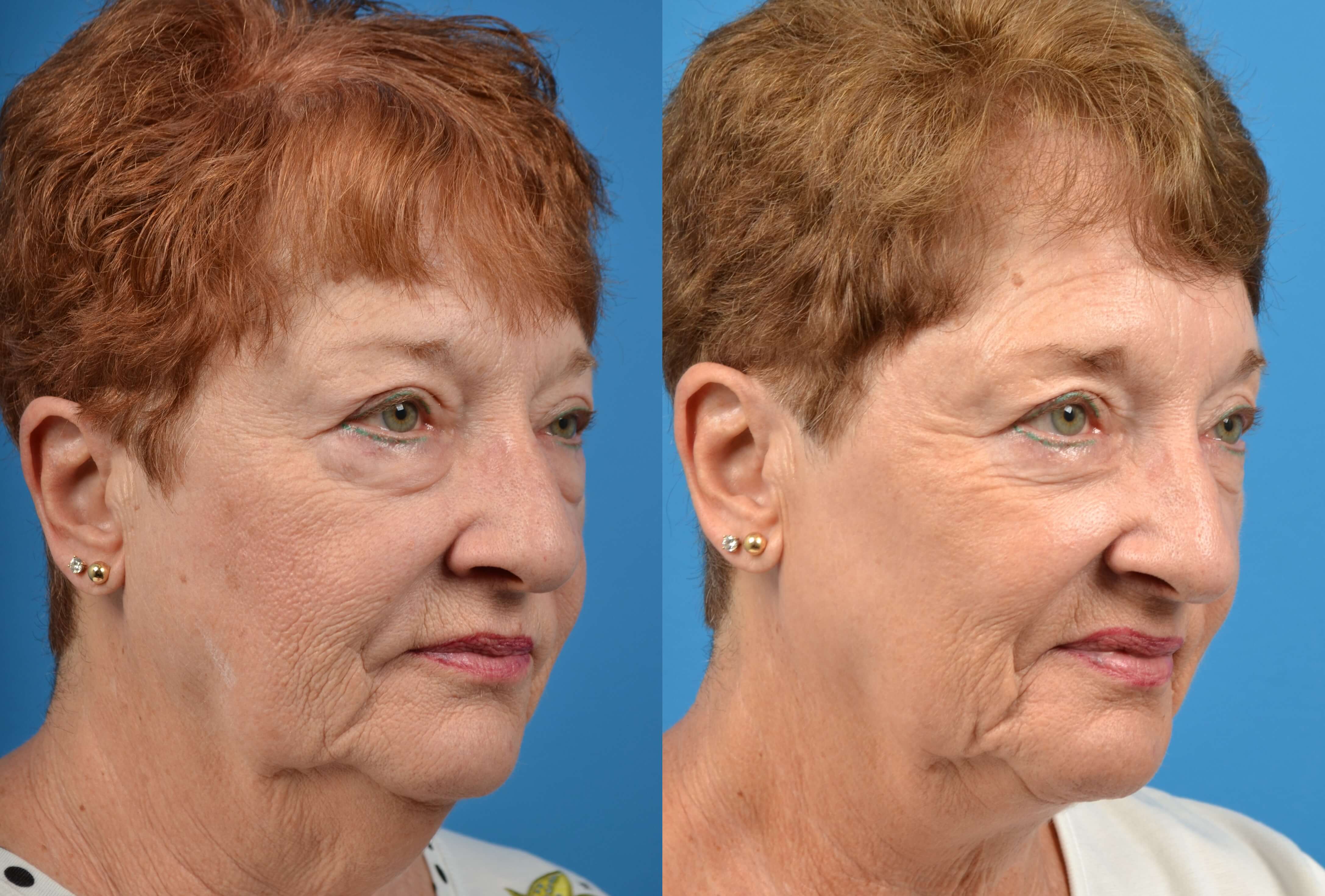 Patient 122406494 Profile Neck Lift Before And After Photos Clevens