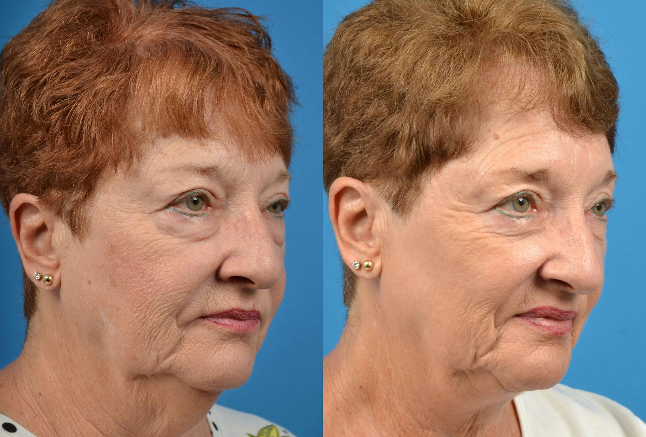 Profile Neck Lift Before & After Gallery - Patient 122406494 - Image 4