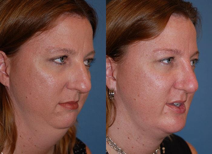 Laser Assisted Weekend Neck Lift Before & After Gallery - Patient 122406495 - Image 1