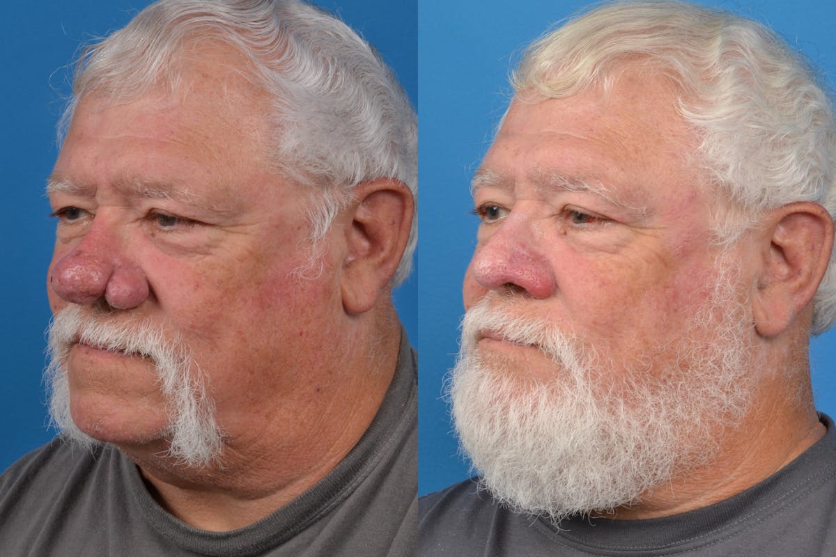 Rhinophyma Before & After Gallery - Patient 122406496 - Image 4