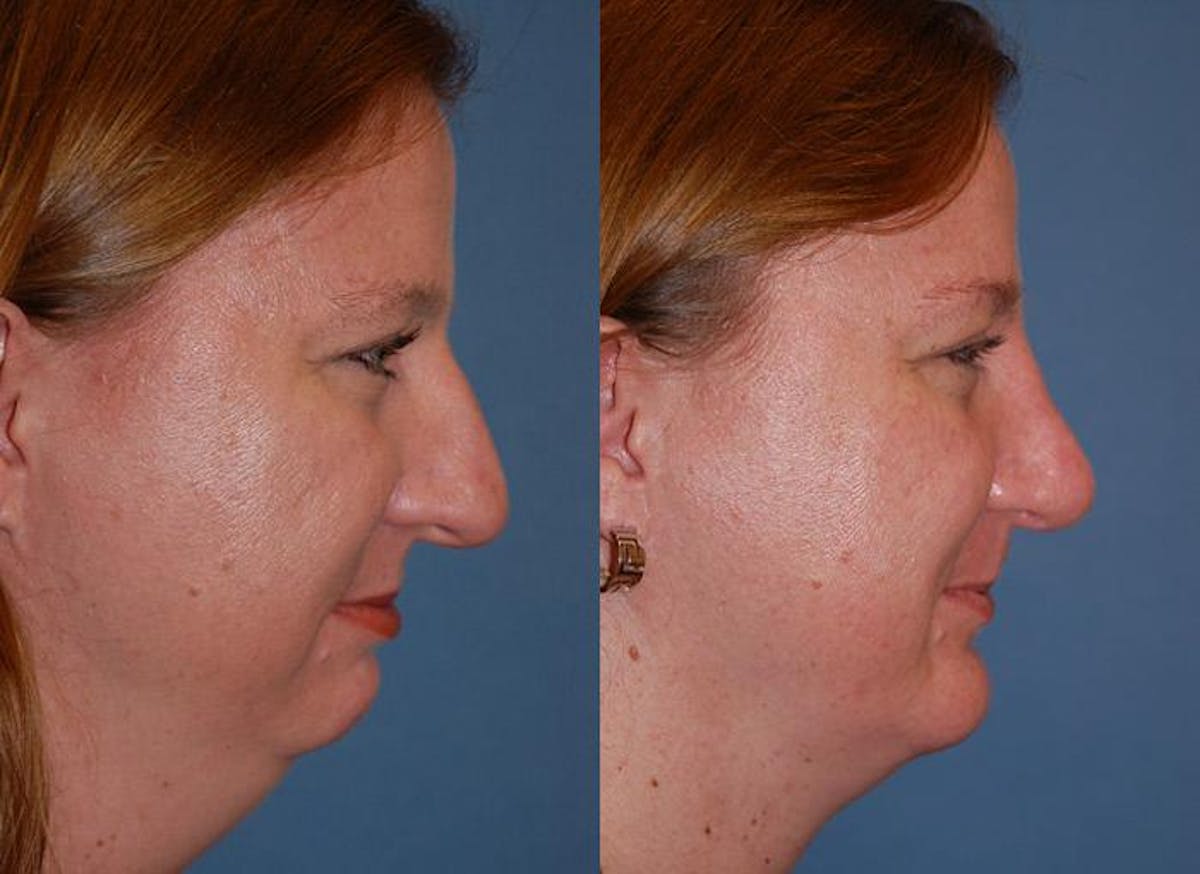 Laser Assisted Weekend Neck Lift Before & After Gallery - Patient 122406495 - Image 2