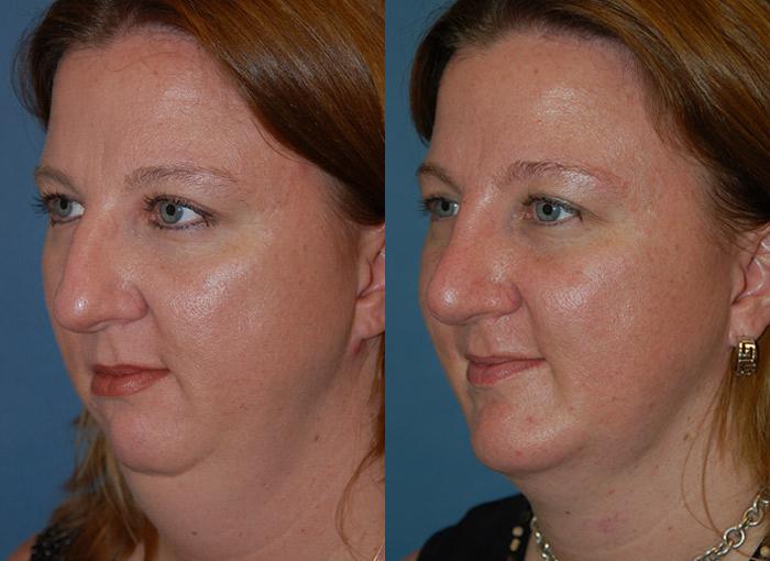 Laser Assisted Weekend Neck Lift Before & After Gallery - Patient 122406495 - Image 3