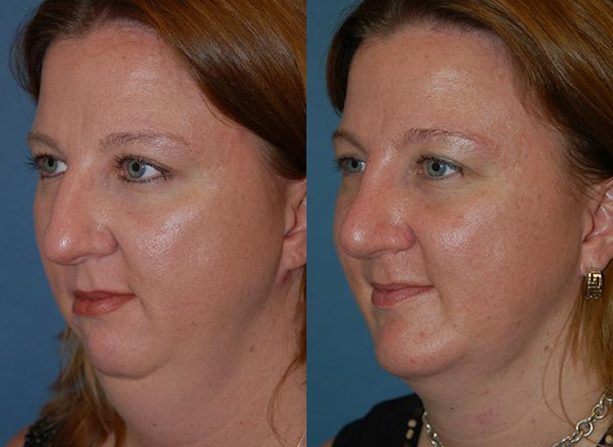 Laser Assisted Weekend Neck Lift Before & After Gallery - Patient 122406495 - Image 3