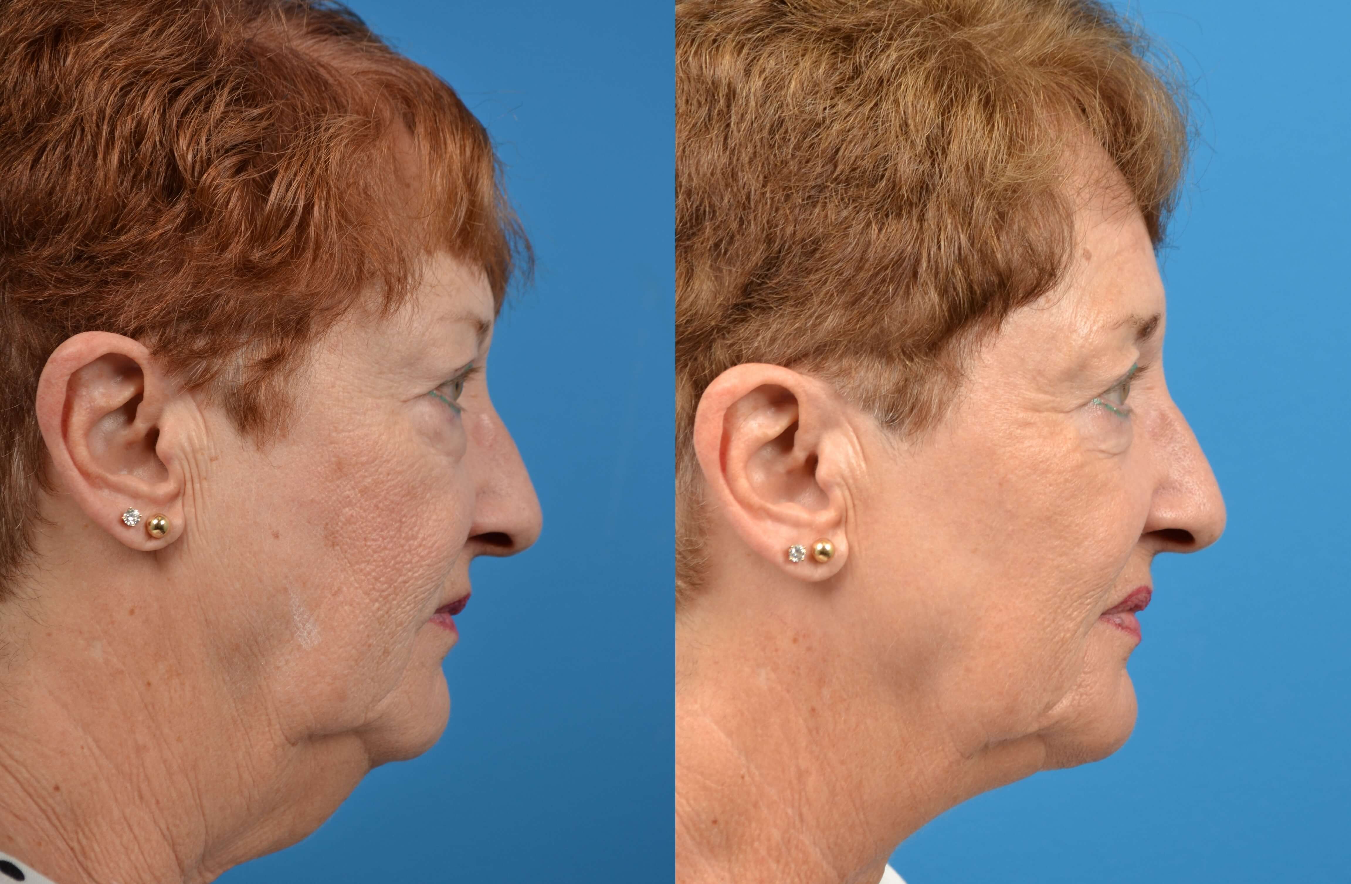 Profile Neck Lift Before & After Gallery - Patient 122406494 - Image 5