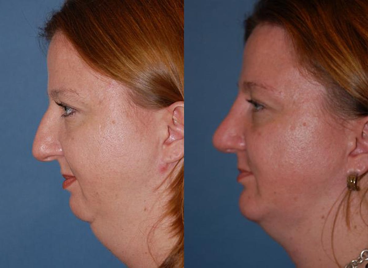 Laser Assisted Weekend Neck Lift Before & After Gallery - Patient 122406495 - Image 4