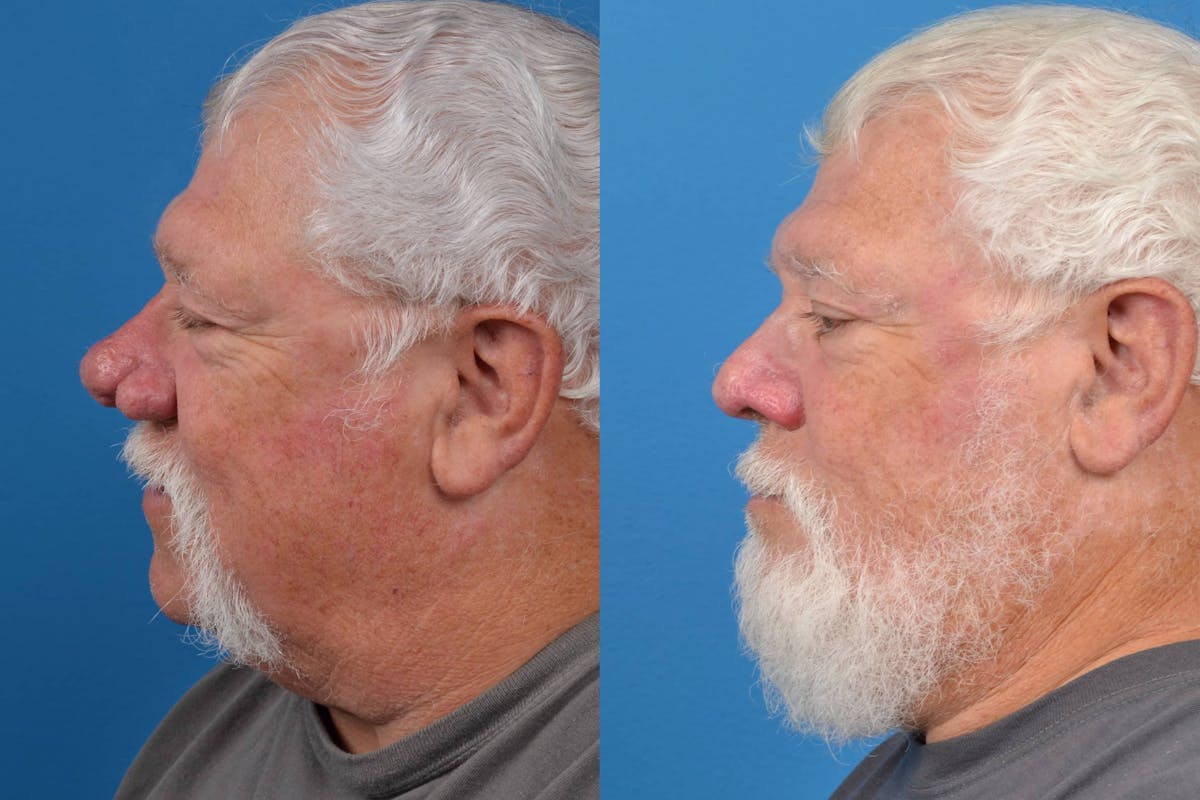 Rhinophyma Before & After Gallery - Patient 122406496 - Image 5