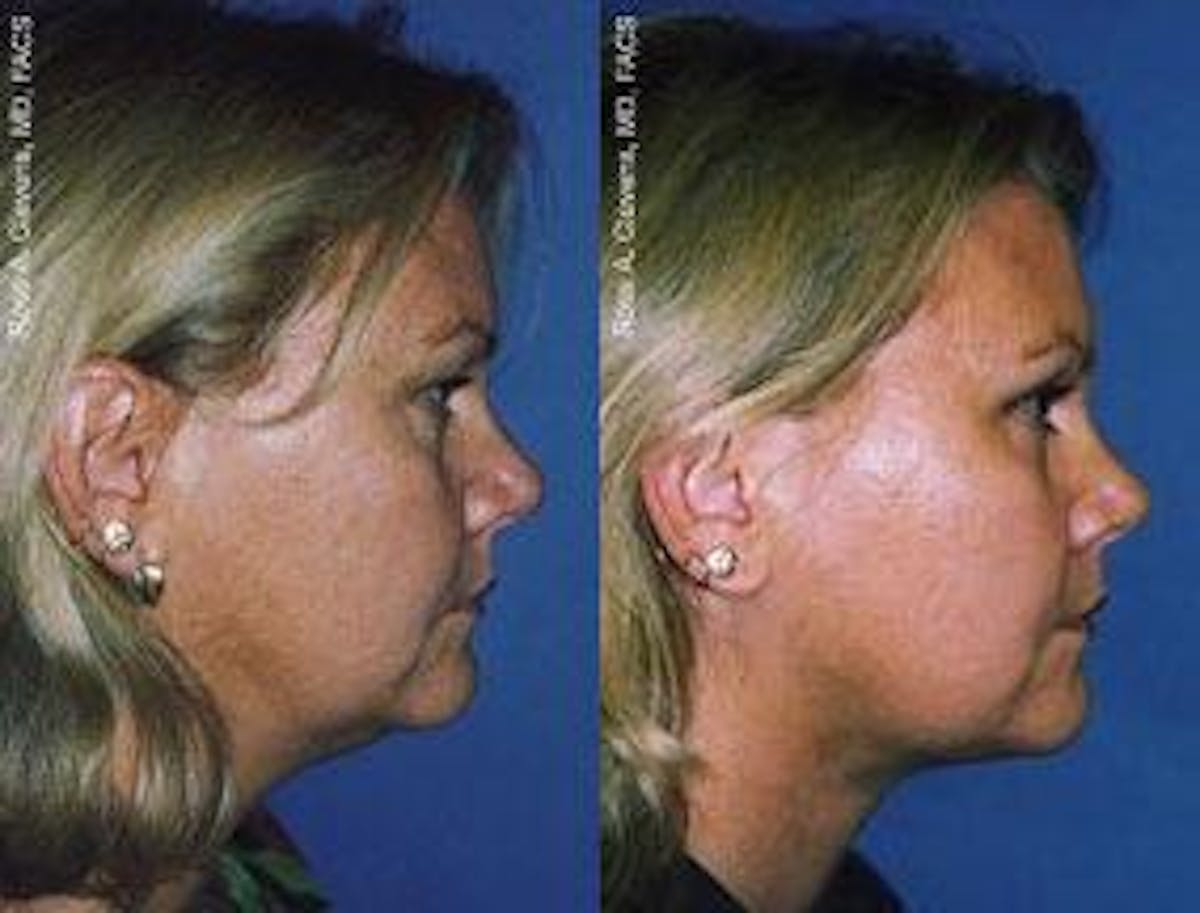 Laser Assisted Weekend Neck Lift Before & After Gallery - Patient 122406497 - Image 1