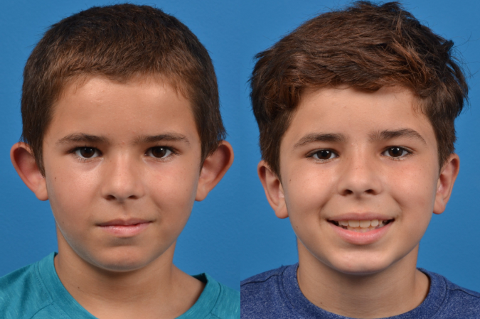 Ear Surgery Before & After Gallery - Patient 122406505 - Image 1