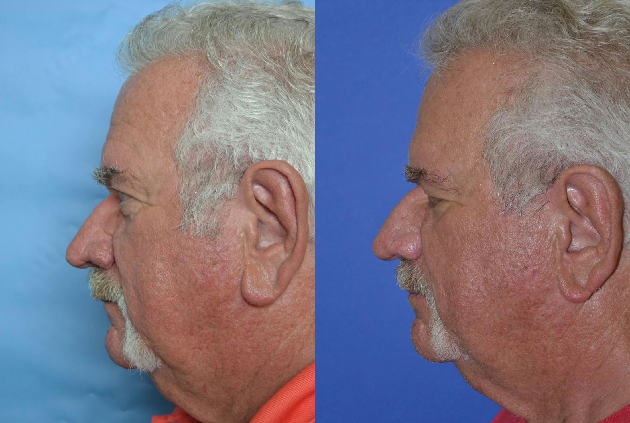 Rhinophyma Before & After Gallery - Patient 122406507 - Image 2
