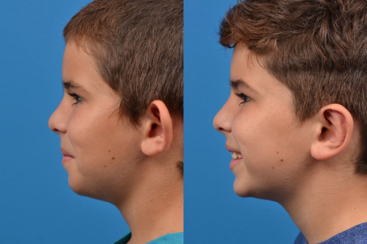 Ear Surgery Before & After Gallery - Patient 122406505 - Image 3