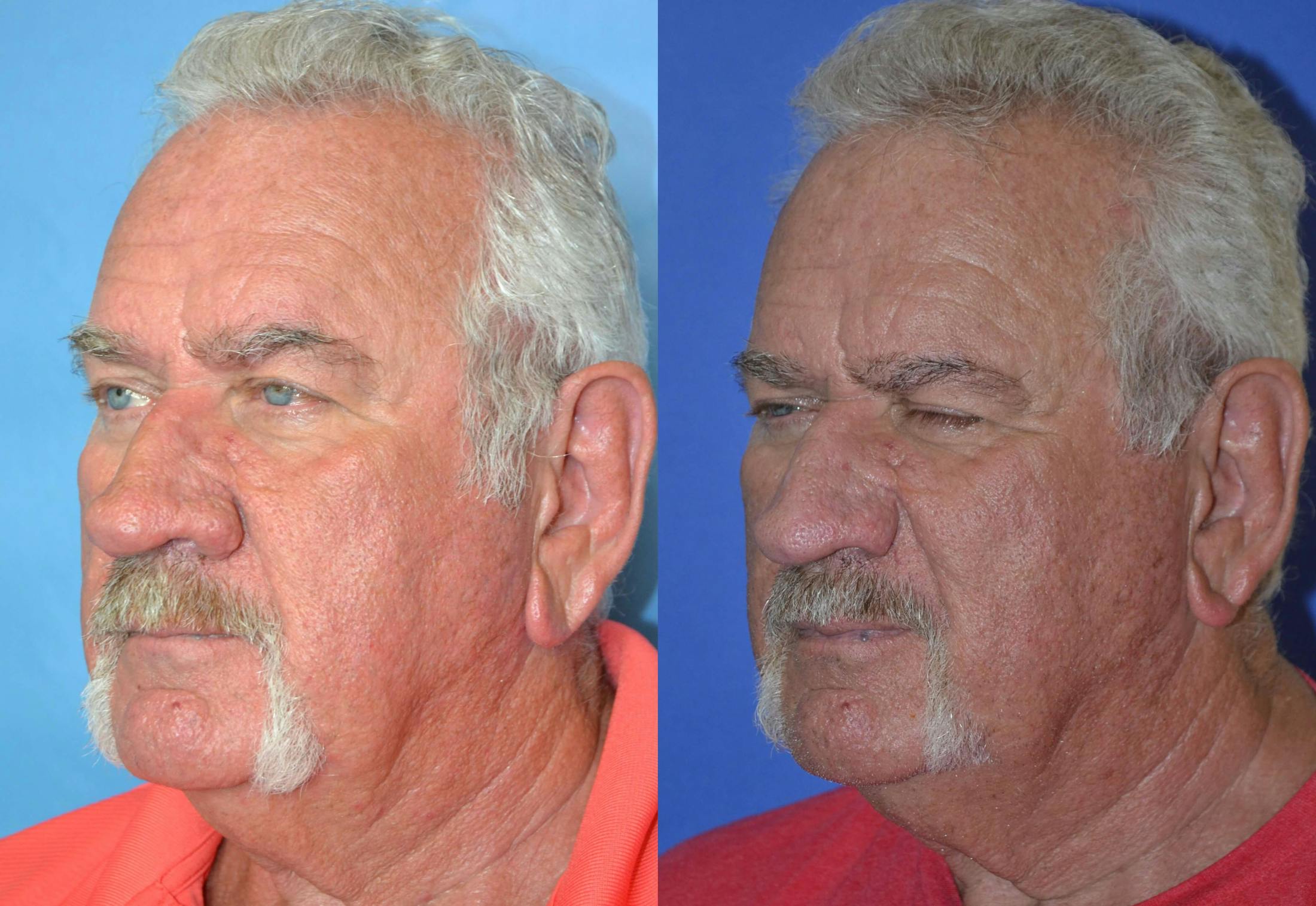 Rhinophyma Before & After Gallery - Patient 122406507 - Image 3