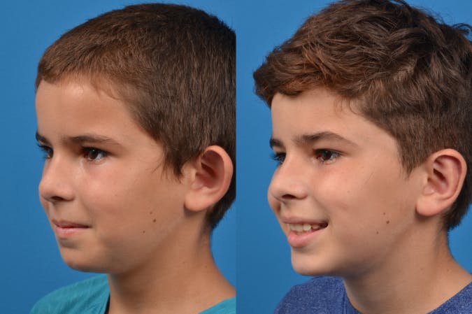 Ear Surgery Before & After Gallery - Patient 122406505 - Image 4
