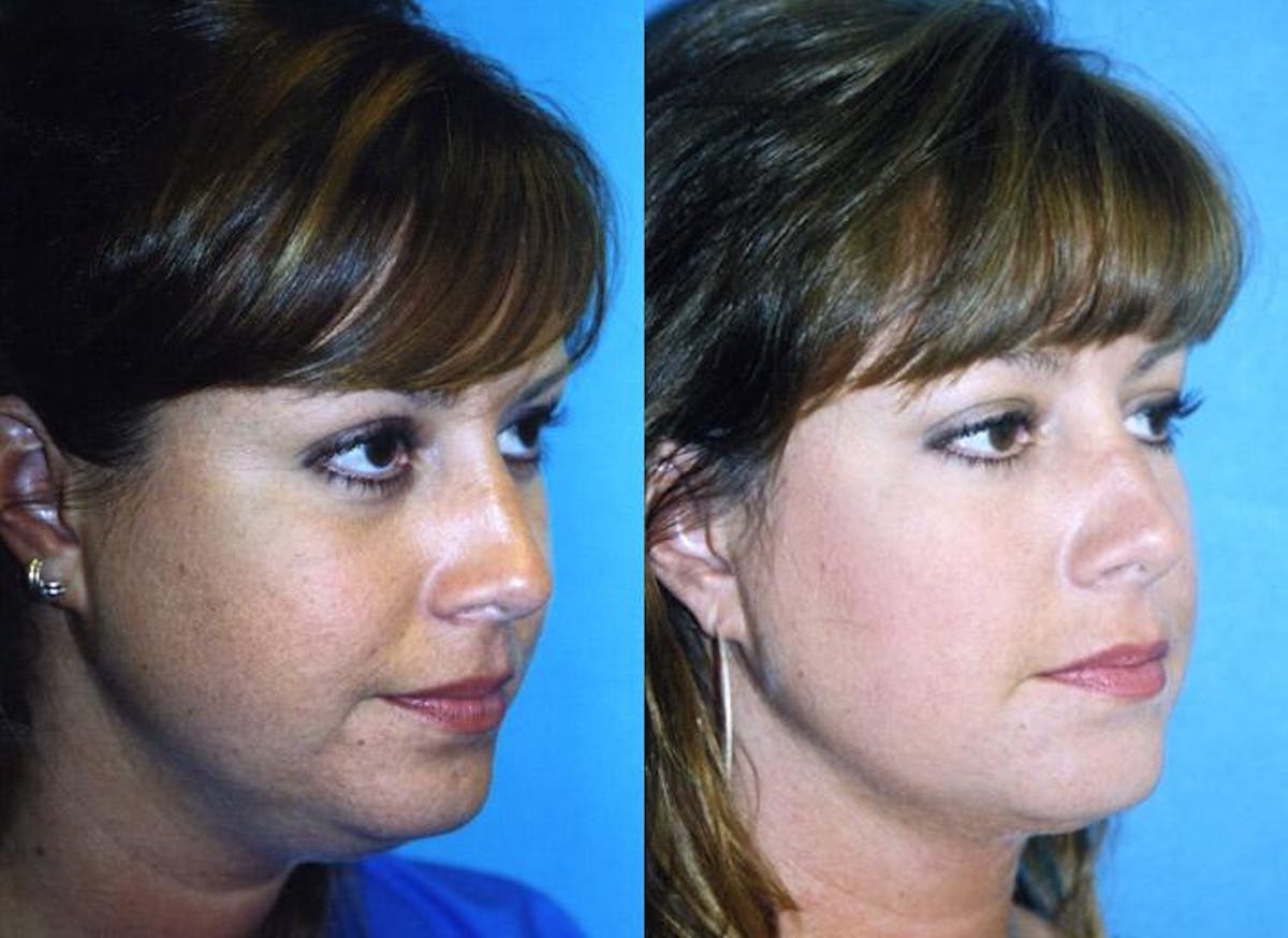 Laser Assisted Weekend Neck Lift Before & After Gallery - Patient 122406502 - Image 1