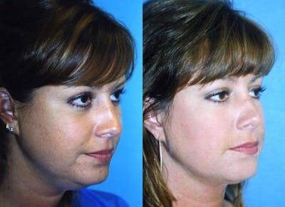 Laser Assisted Weekend Neck Lift Before & After Gallery - Patient 122406502 - Image 1