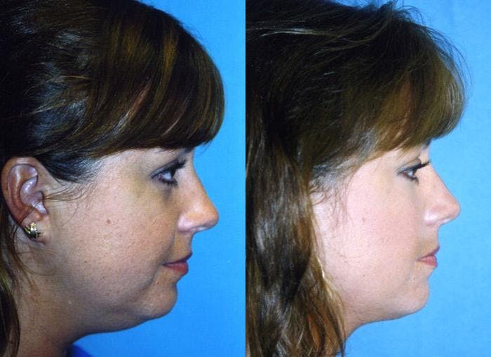 Laser Assisted Weekend Neck Lift Gallery - Patient 122406502 - Image 2