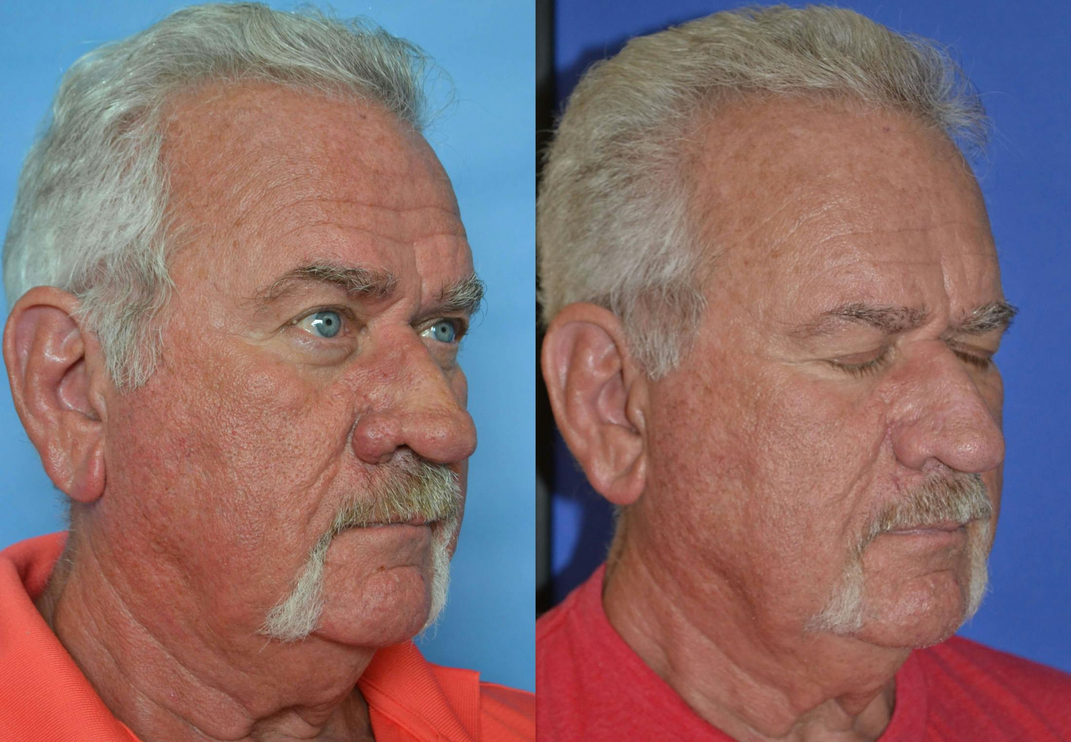 Rhinophyma Before & After Gallery - Patient 122406507 - Image 4