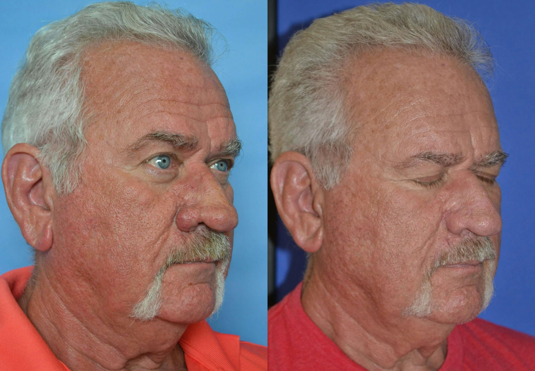 Rhinophyma Before & After Gallery - Patient 122406507 - Image 4