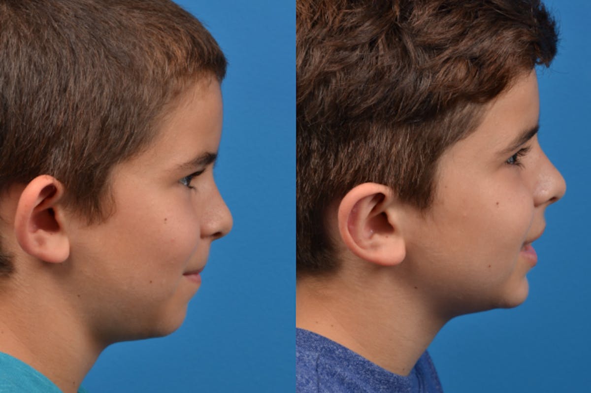 Ear Surgery Before & After Gallery - Patient 122406505 - Image 5