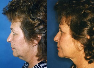 Laser Assisted Weekend Neck Lift Before & After Gallery - Patient 122406503 - Image 1