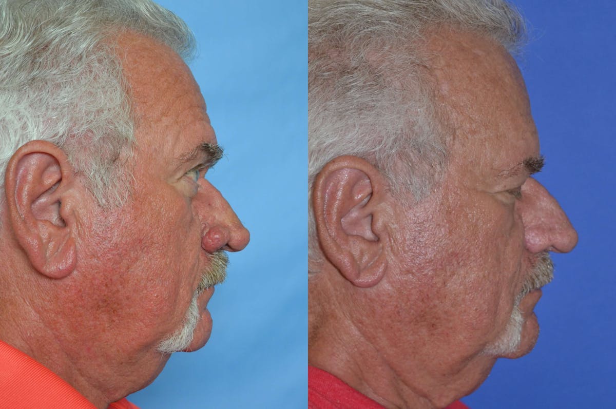 Rhinophyma Before & After Gallery - Patient 122406507 - Image 5
