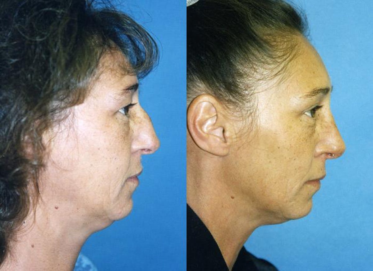 Laser Assisted Weekend Neck Lift Before & After Gallery - Patient 122406506 - Image 1