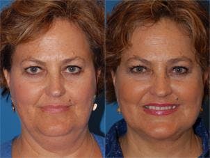 Laser Assisted Weekend Neck Lift Before & After Gallery - Patient 122406509 - Image 1