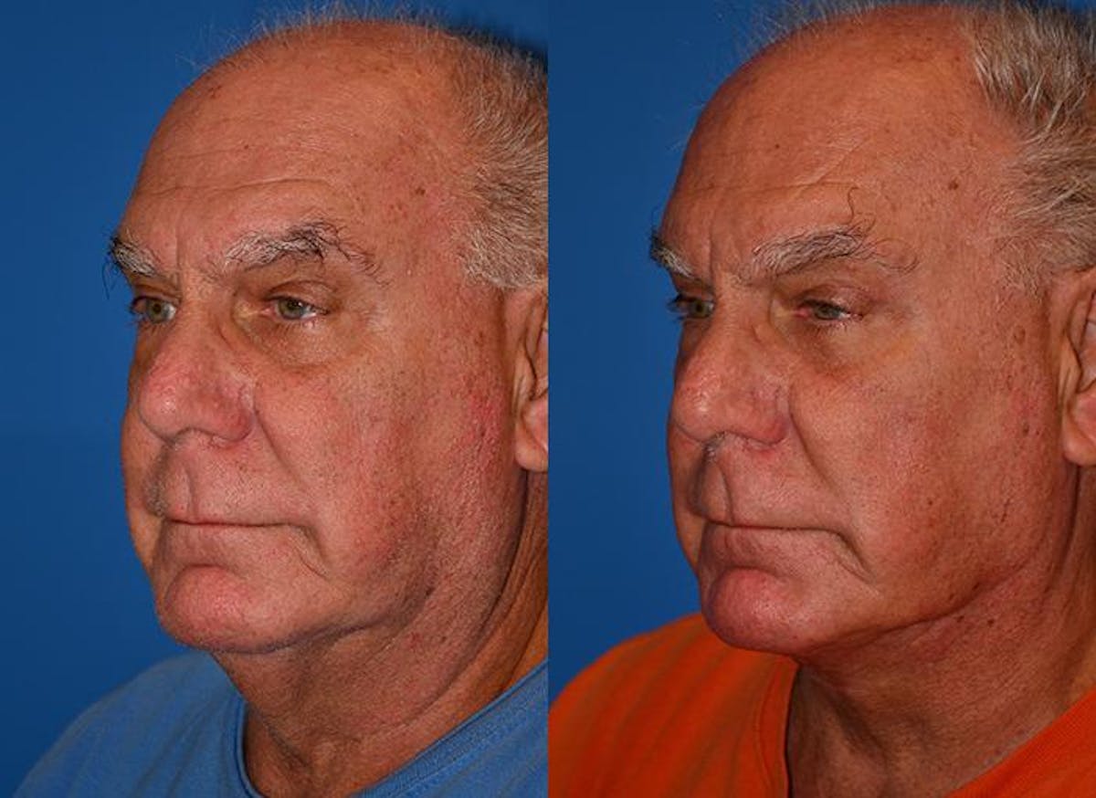 Profile Neck Lift Before & After Gallery - Patient 122406508 - Image 2