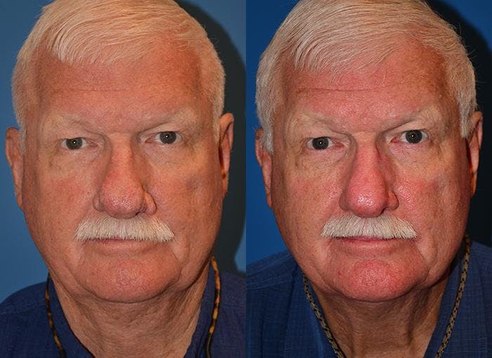 Rhinophyma Before & After Gallery - Patient 122406510 - Image 1