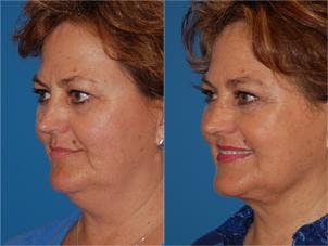Laser Assisted Weekend Neck Lift Before & After Gallery - Patient 122406509 - Image 2