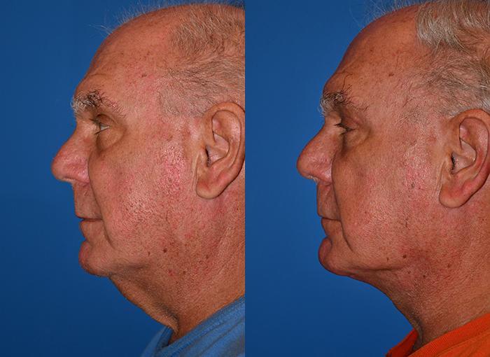 Profile Neck Lift Before & After Gallery - Patient 122406508 - Image 3