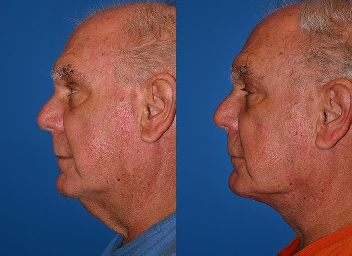 Profile Neck Lift Before & After Gallery - Patient 122406508 - Image 3