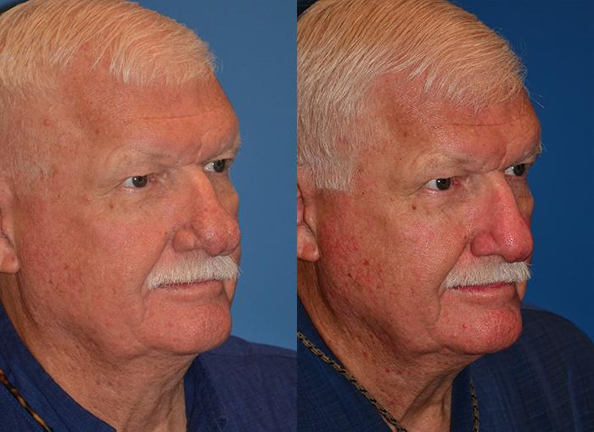 Rhinophyma Before & After Gallery - Patient 122406510 - Image 2