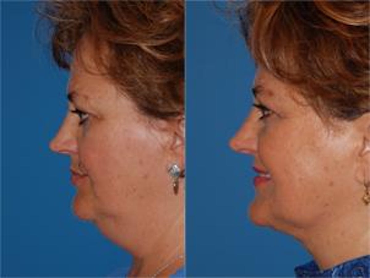 Laser Assisted Weekend Neck Lift Before & After Gallery - Patient 122406509 - Image 3