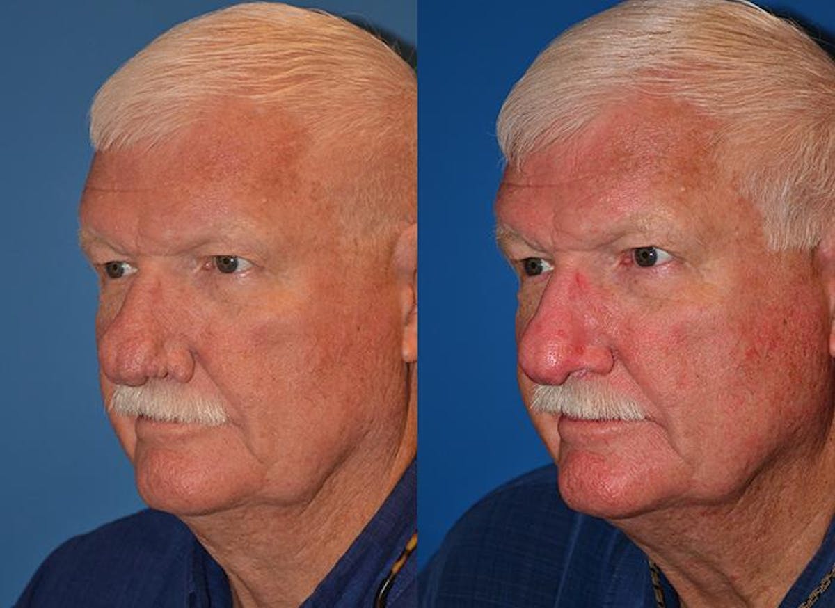 Rhinophyma Before & After Gallery - Patient 122406510 - Image 3