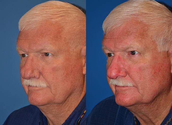 Rhinophyma Before & After Gallery - Patient 122406510 - Image 3