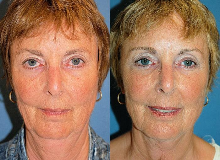 Profile Neck Lift Before & After Gallery - Patient 122406512 - Image 1