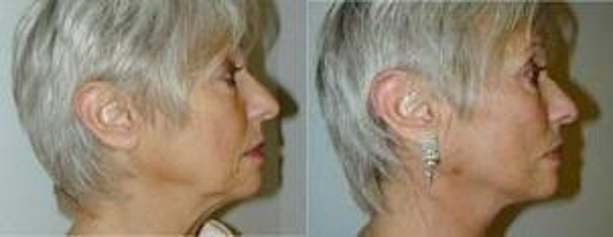 Laser Assisted Weekend Neck Lift Before & After Gallery - Patient 122406511 - Image 1