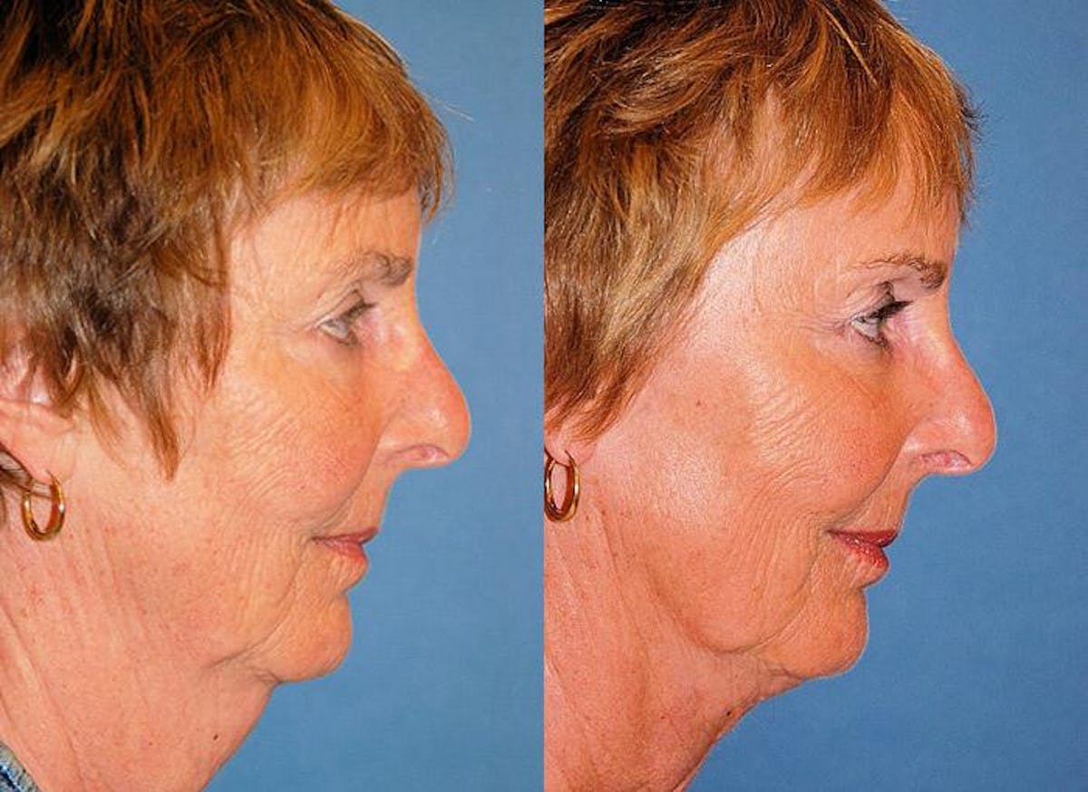 Profile Neck Lift Before & After Gallery - Patient 122406512 - Image 2