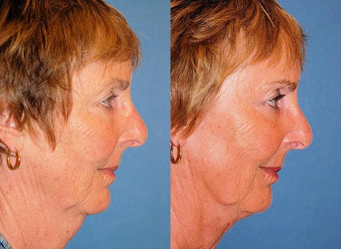 Profile Neck Lift Before & After Gallery - Patient 122406512 - Image 2