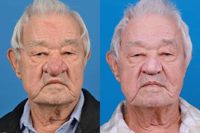 Rhinophyma Before & After Gallery - Patient 122406516 - Image 1
