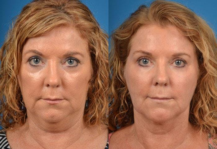 Laser Assisted Weekend Neck Lift Before & After Gallery - Patient 122406514 - Image 1