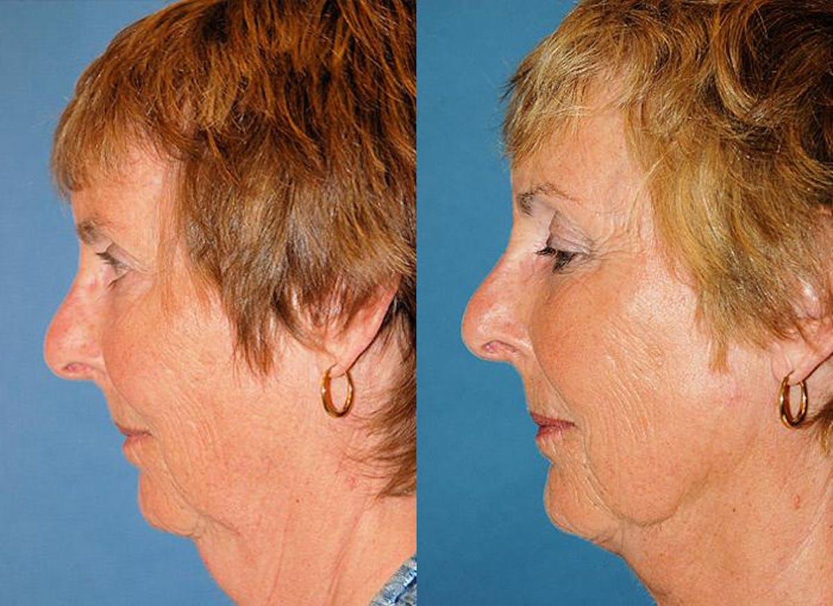 Profile Neck Lift Before & After Gallery - Patient 122406512 - Image 3