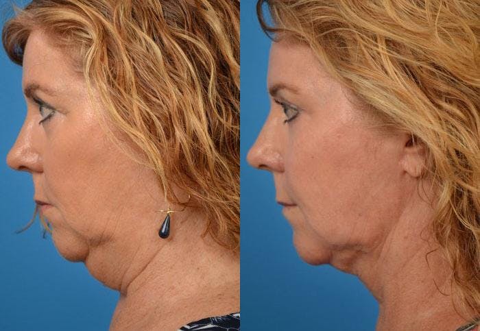 Laser Assisted Weekend Neck Lift Before & After Gallery - Patient 122406514 - Image 2