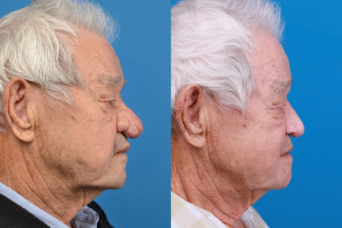 Rhinophyma Before & After Gallery - Patient 122406516 - Image 2